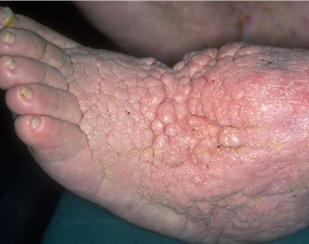 papillomatosis cutis lomper pinworm kezelés
