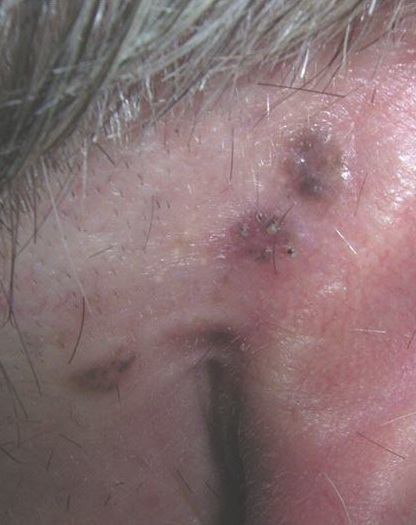Pigmented Basal Cell Carcinoma - Risks, Symptoms and ...