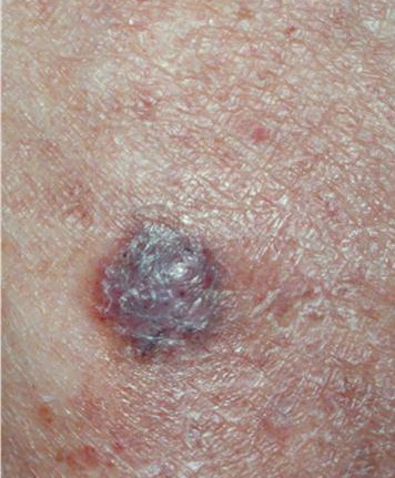 pigmented basal cell carcinoma