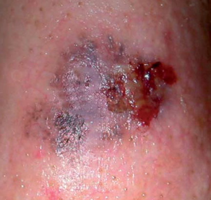 pigmented basal cell carcinoma #11