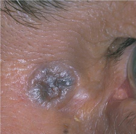 Pigmented basal cell carcinoma Symptoms, Diagnosis ...