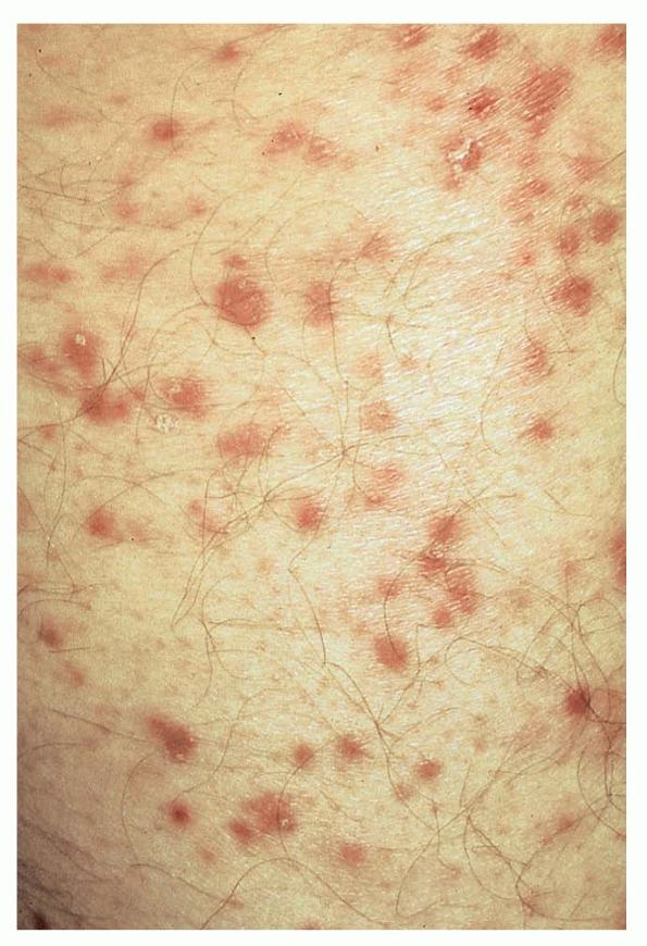 What Is Pityriasis Lichenoides Chronica