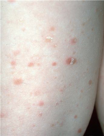 Pityriasis Lichenoides - American Osteopathic College of ...