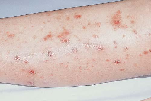 keratosis-lichenoides-chronica-pictures-photos