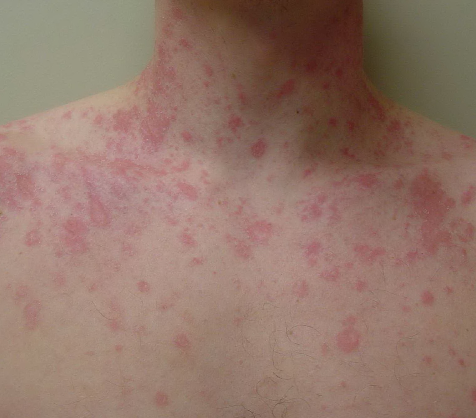 pityriasis rosea pictures