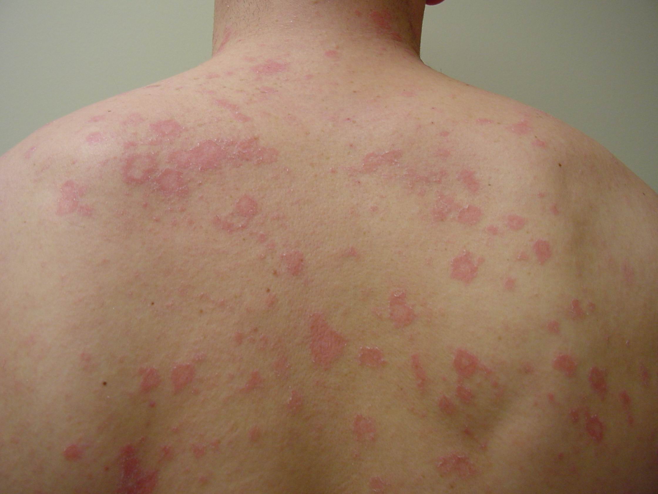 Treatments For Pityriasis Rosea Herald Patch Getfilecloud