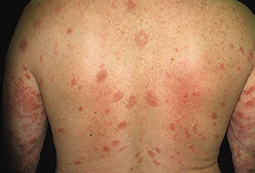 Tinea Versicolor Relief & Treatment - Natural Skin Care ...