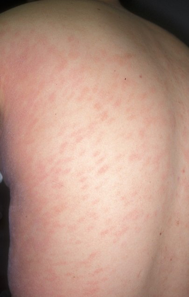 viral exanthem in adults - pictures, photos