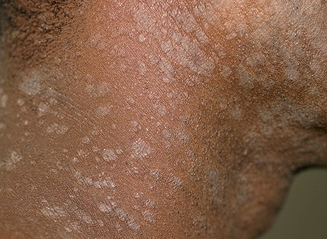 Pityriasis Rosea Symptoms, Treatments, Causes - WebMD