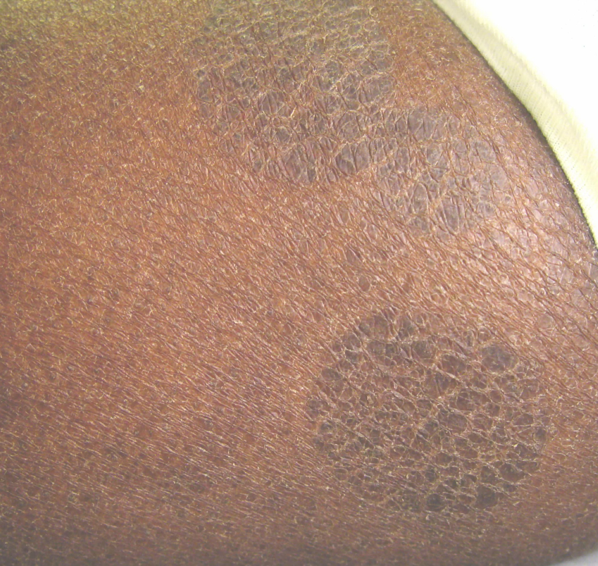 Ziekte van Gibert, pityriasis rosea, huiduitslag