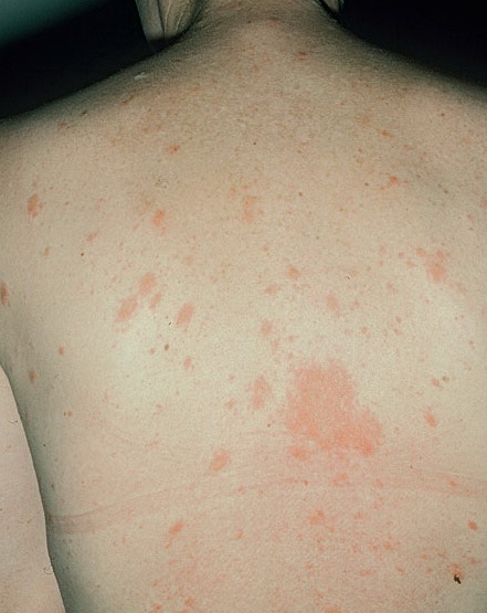 Pityriasis Rosea Photo Pictures Photos