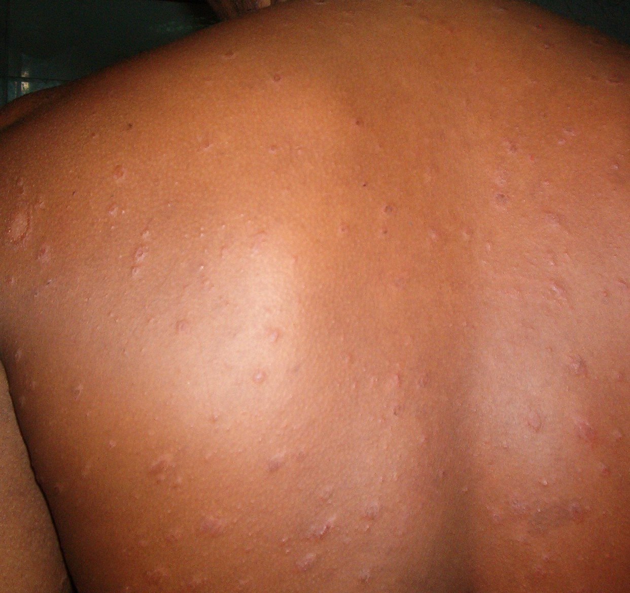 Pityriasis Rosea Picture Image on MedicineNet.com