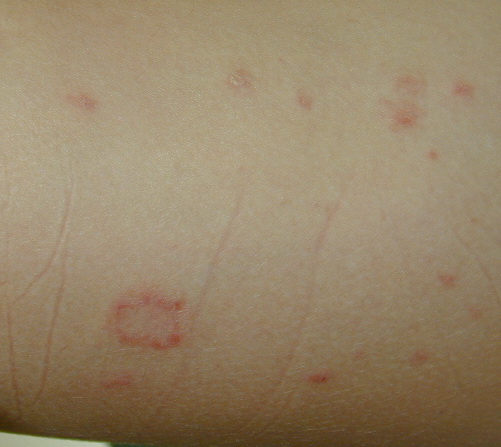 Treatments For Pityriasis Rosea Herald Patch