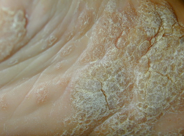 pictures of plantar warts