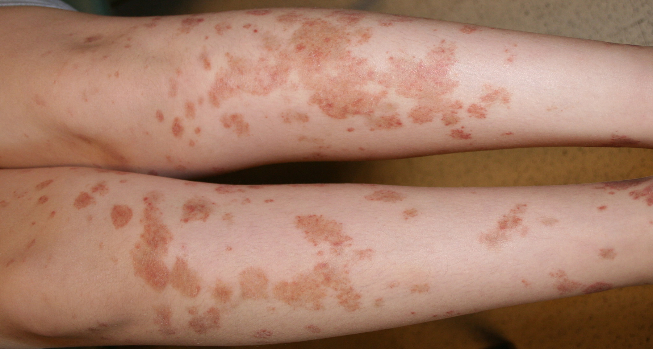 Pigmented Purpuric Dermatoses Information and Causes | Patient