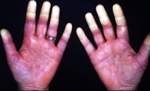 raynaud phenomenon images