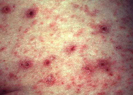 what is crusted scabies #10