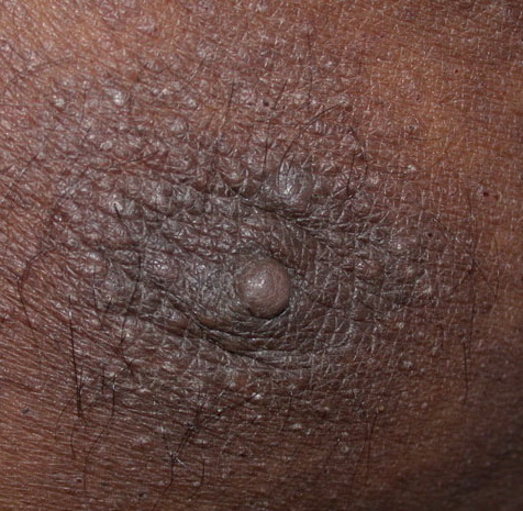 Scabies Pictures: Rash, Skin Infections, Itching, Symptoms ...