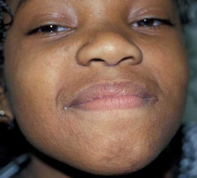 Scarlet Fever Rash On Black Skin