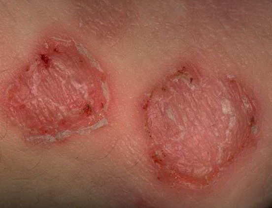 Sycosis Barbae Photos - Dermatology Education