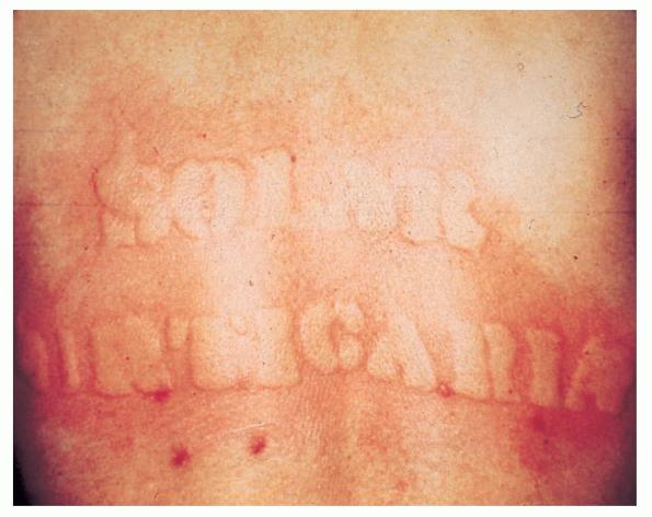 Hives | American Academy of Dermatology