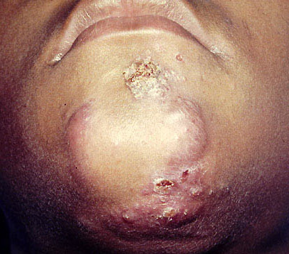 Dermatology Image Library - Images for Dermatologists ...