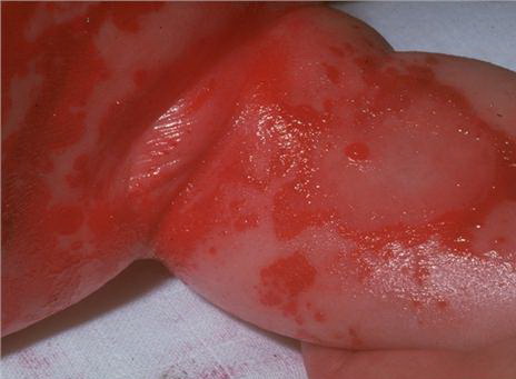 staph scalded skin syndrome