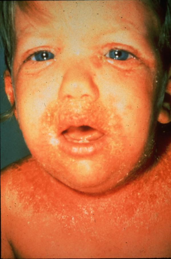 Staphylococcal Scalded Skin Syndrome (SSSS) in Children ...