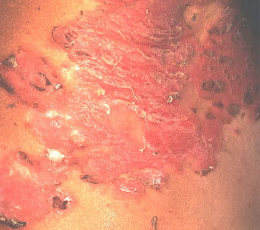 Staphylococcal scalded skin syndrome - Wikipedia