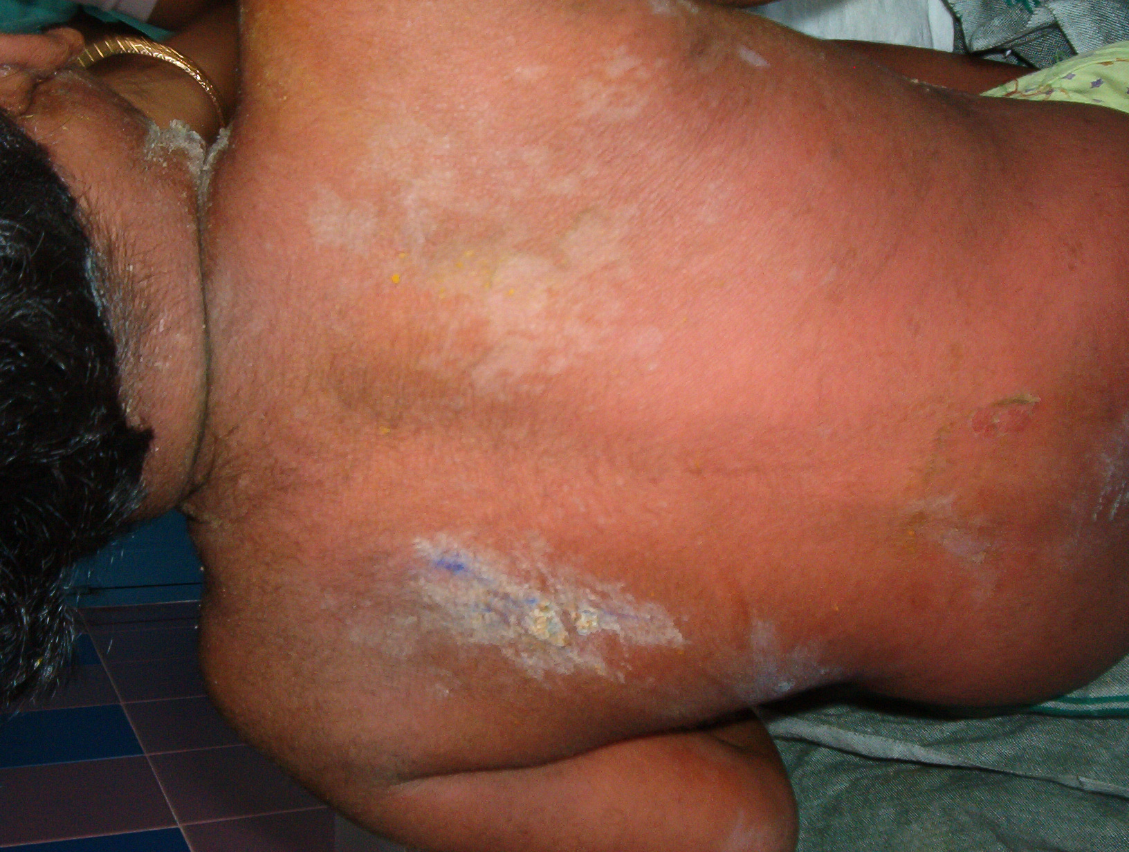 Staphylococcal scalded skin syndrome | DermNet New Zealand