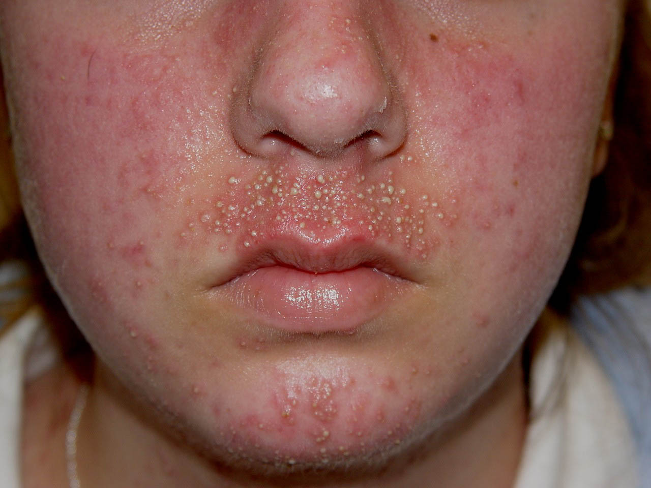 Steroid Induced Rosacea