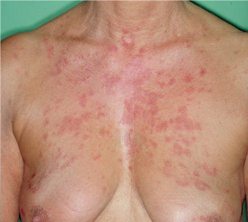 Cutaneous lupus erythematosus | DermNet New Zealand