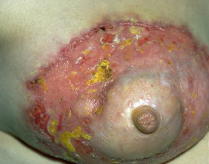pictures of syphilis