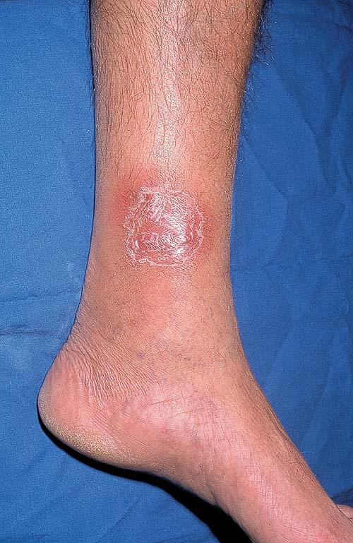 Understanding Thrombophlebitis -- the Basics - WebMD