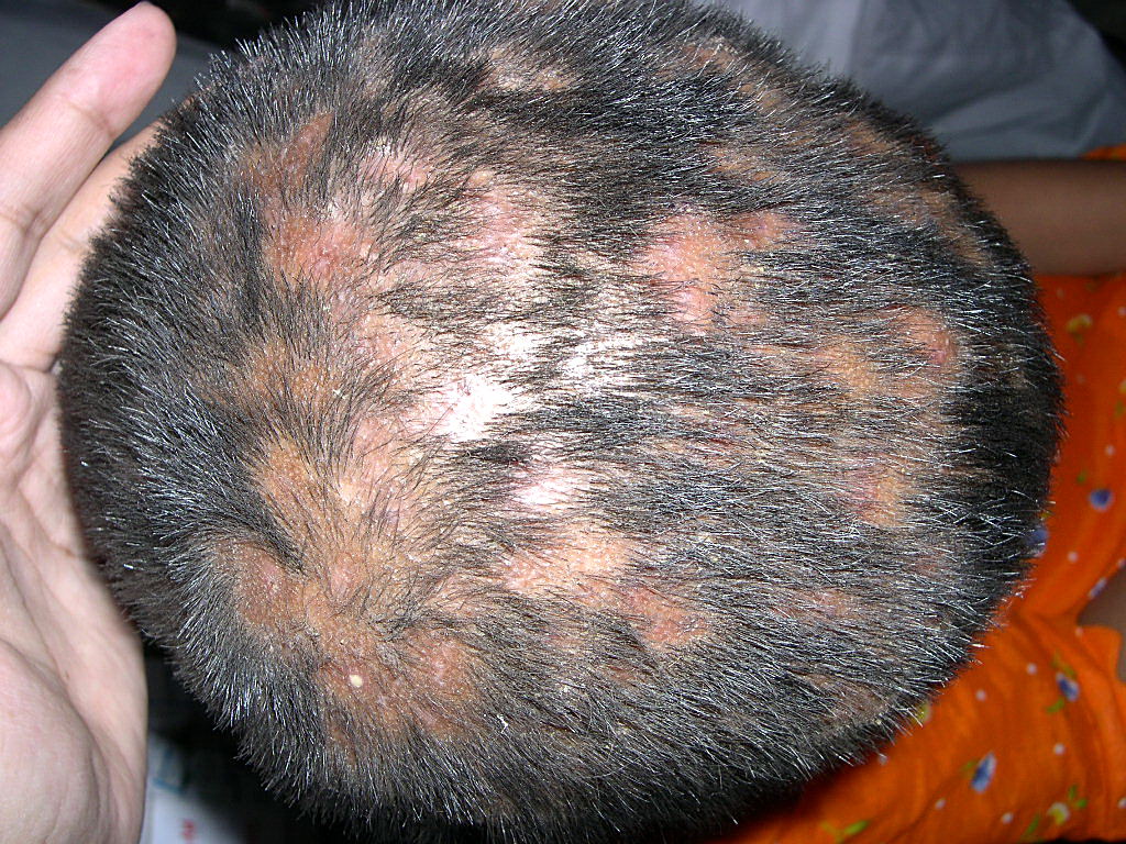 Tinea capitis (schimmelinfectie van het behaarde hoofd)
