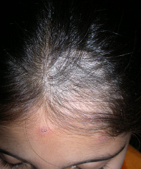 Tinea Capitis (Scalp Ringworm, Hair Fungal Infection ...