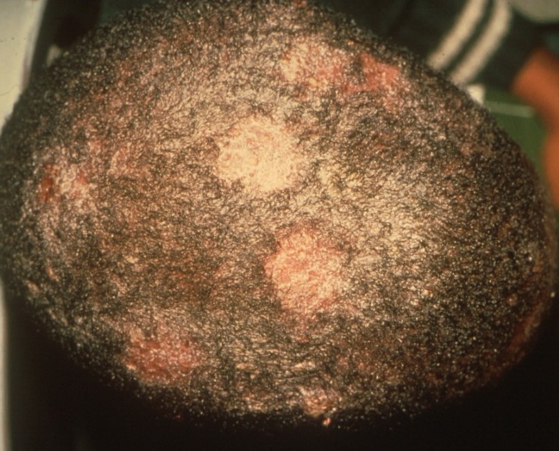 Picture of Ringworm of the Scalp (Tinea Capitis) - WebMD