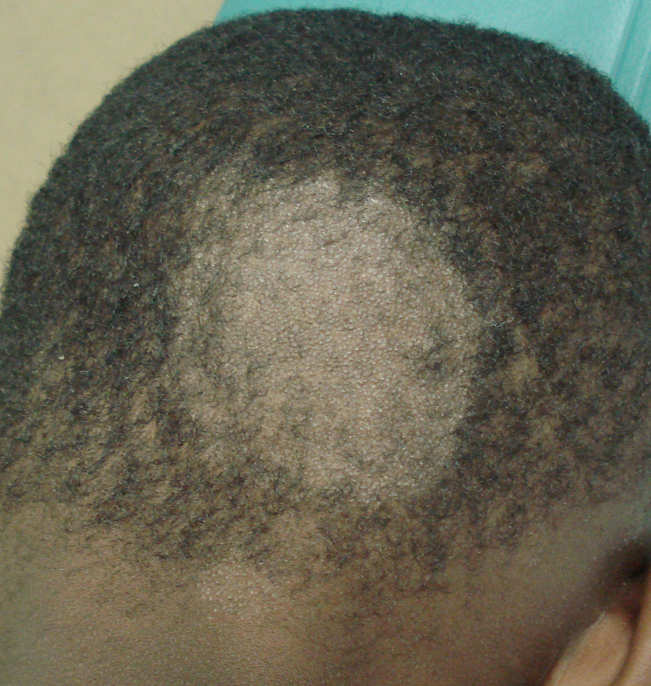 tinea capitis treatment