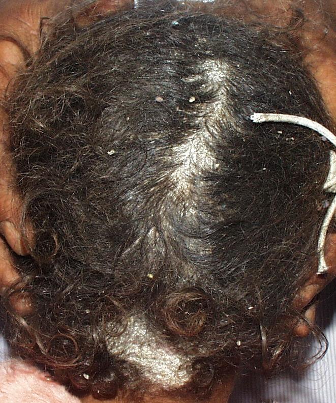 Ringworm, Scalp (Tinea Capitis) Condition, Treatments, and ...