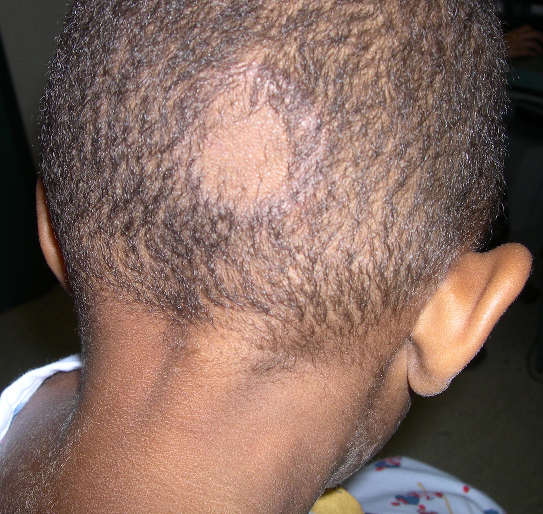 Tinea Capitis Picture Pictures Photos