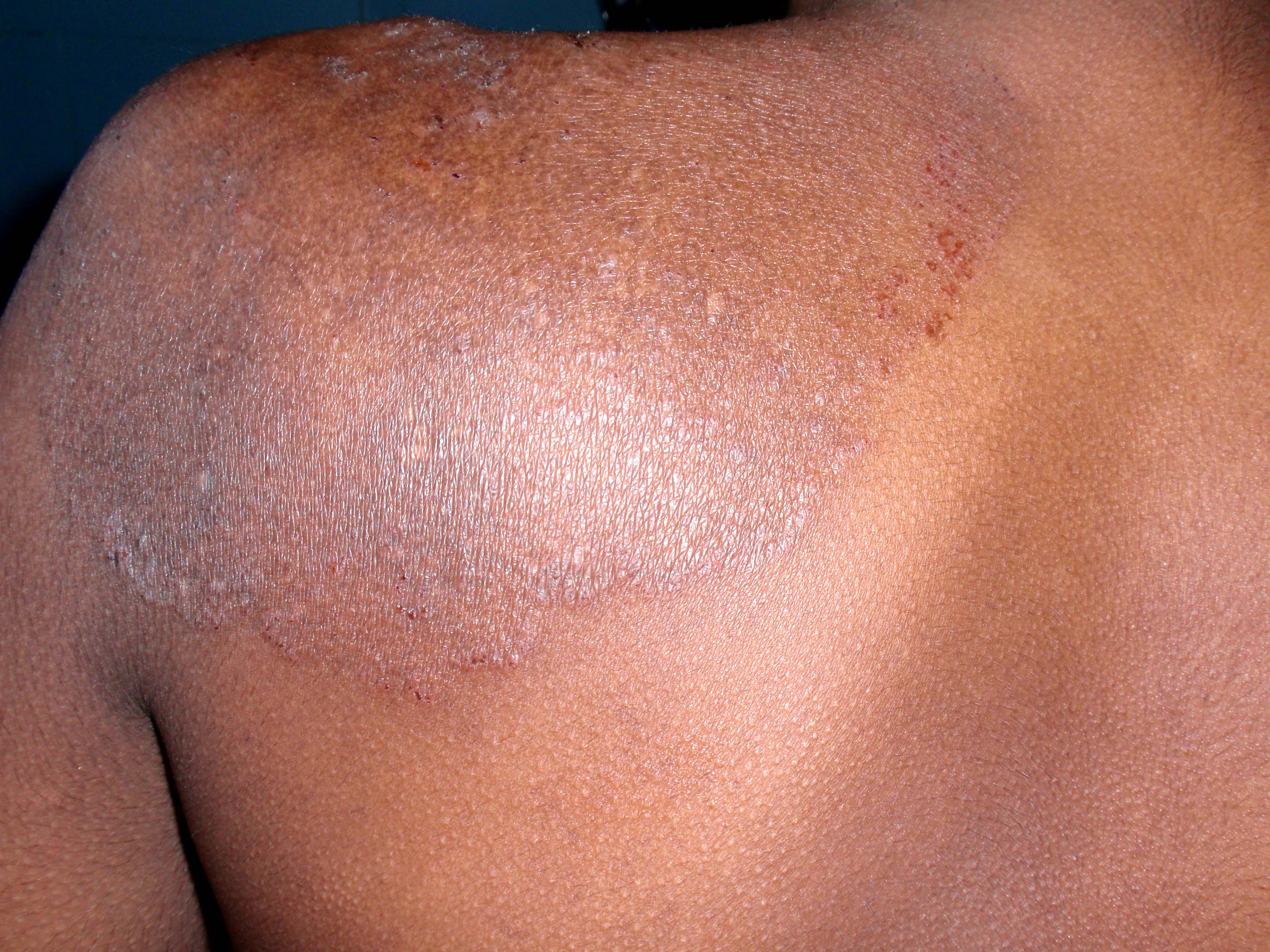 Tinea Corporis 