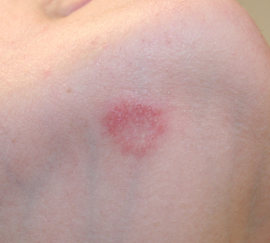 tinea corporis pictures