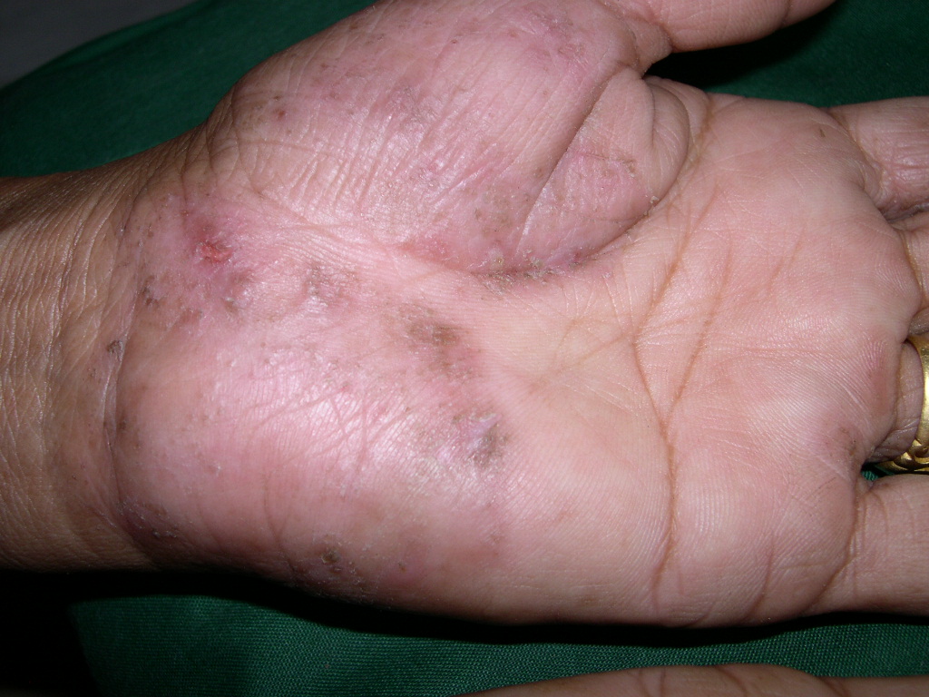 Diagnosis and Management of Common Tinea Infections ...