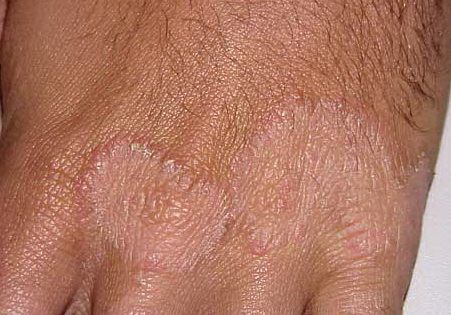 Tinea Manuum (Hand Fungus) Causes, Symptoms, Pictures ...