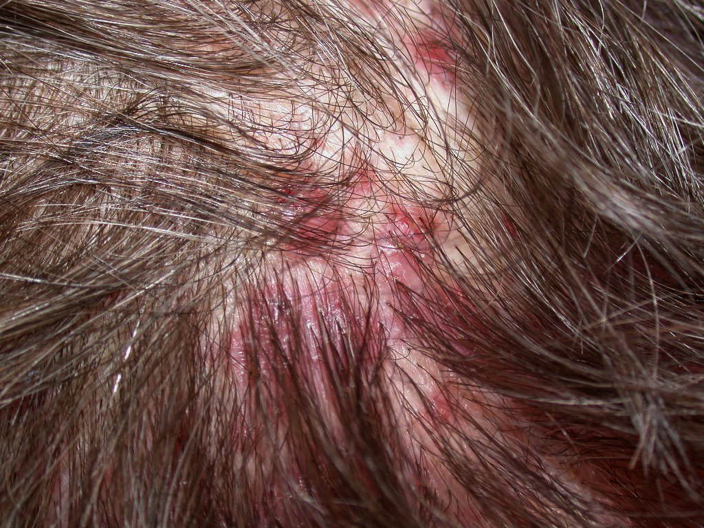 Hair Loss — Pictures Diagnosisdude