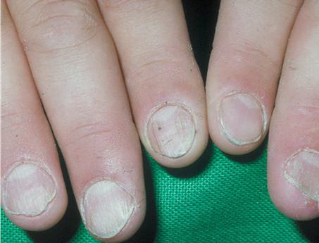 Twenty-nail dystrophy | Genetic and Rare Diseases ...