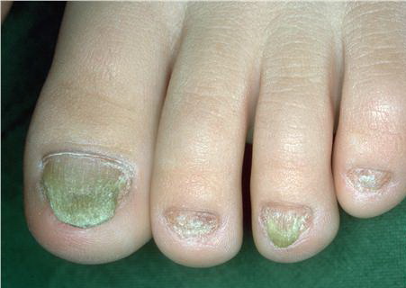 Understanding Nail Dystrophy | Nuvail