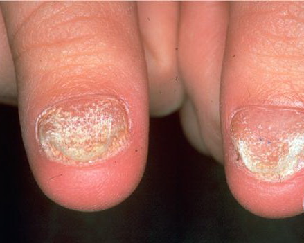twenty nail dystrophy