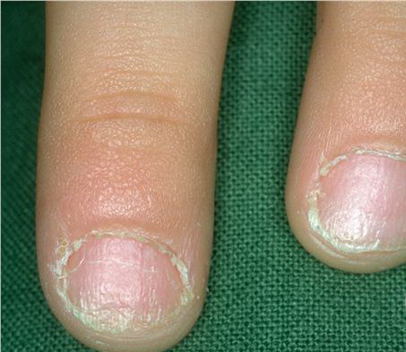 Twenty-nail dystrophy | Genetic and Rare Diseases ...