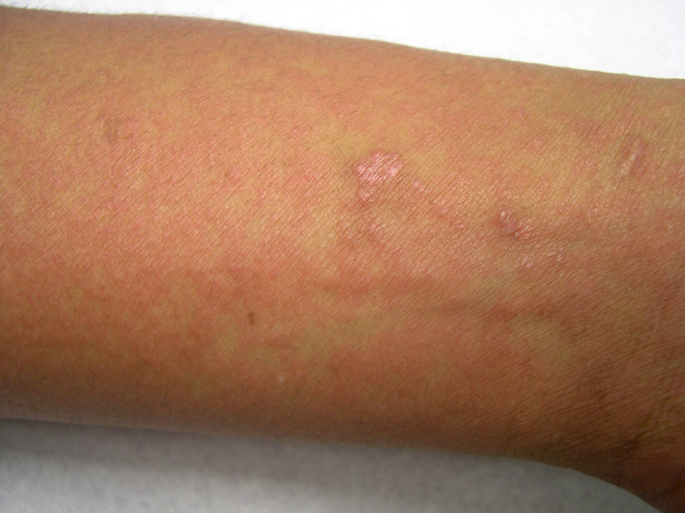 Picture of Hives (urticaria) - WebMD